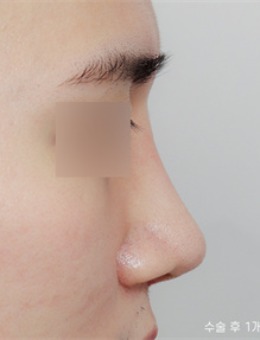 韩国nplus整形外科做鼻子技术好!是韩国本土人气医院!_术后