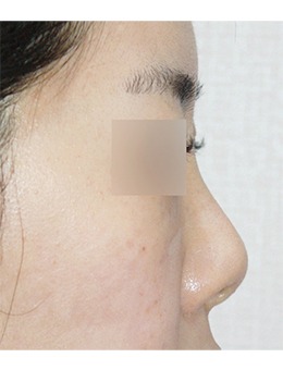 分享韩国nplus整形外科鼻整形前后对比，精致感手拿把掐