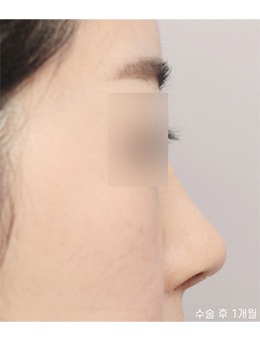 分享韩国nplus整形外科鼻整形前后对比，精致感手拿把掐