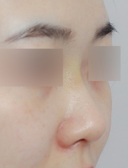 韩国Nplus恩普路斯整形外科做鼻子很出名,鼻整形对比图超惊艳!_术前