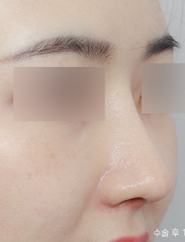 韩国Nplus恩普路斯整形外科做鼻子很出名,鼻整形对比图超惊艳!_术后