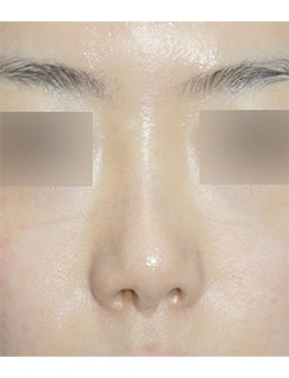 韩国nplus整形外科尹贤哲医生鼻部矫正手术超棒！真实手术对比图证明审美优势