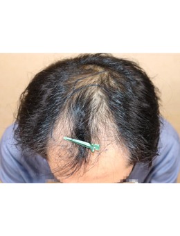 -韩国永长植发医院6100个毛囊面积图和植发前后对比照分享!
