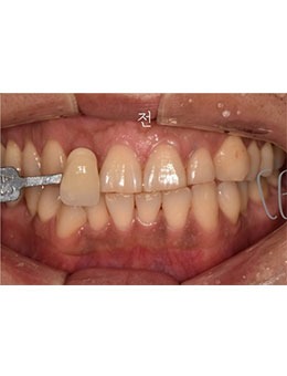 le牙科医院做牙齿美白很自然!在韩国le牙科是排行榜上医院!