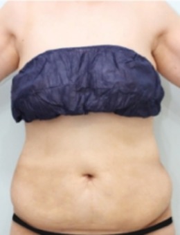 -韩国腰腹吸脂医院中TANGGLE整形外科排名前十,腰腹环吸做得很棒!