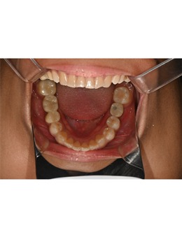韩国补牙医院哪家好?你看过韩国le牙科后牙补牙对比图就有答案了!