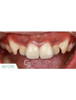 -韩国SMILE VIEW牙科牙齿矫正前后对比图分享，变化真大！