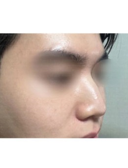 韩国艾迪升整形外科男生隆鼻术后反馈更新，get自然英气鼻子!