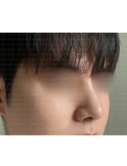 韩国艾迪升整形外科男生隆鼻术后反馈更新，get自然英气鼻子!_术后