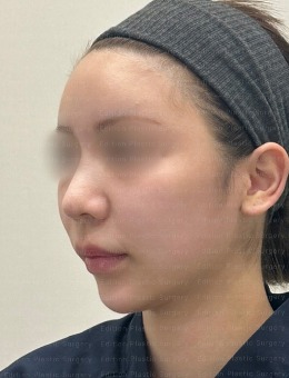 韩国艾迪升整形外科鼻修复做得好,从真人修复鼻子真实经历就能看出!