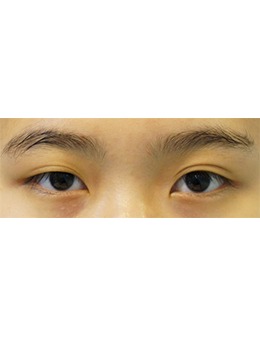 韩国延世YB整形带你了解不开刀的眼睑下垂矫正手术有多神奇~