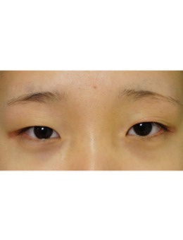 韩国延世YB整形做开眼角+眼睑下垂矫正+全切双眼皮手术出名,附对比照!_术前