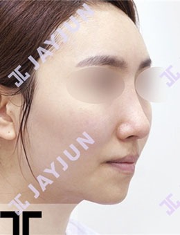 -韩国JAYJUN整形颧骨缩小手术很有名，术后脸型自然柔和！