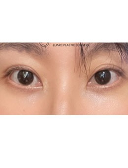 韩国luarc整形眼底脂肪再配置对比图，大眼袋黑眼圈都没了！