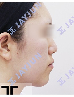 分享JAYJUN捷埈整形外科面部轮廓手术前后对比图！改善面部轮廓问题重获饱满流畅的少女脸