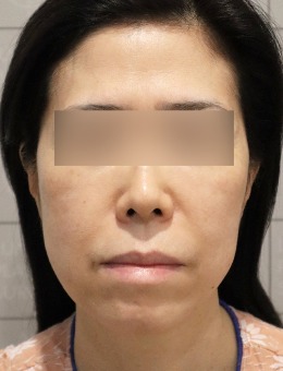 韩国luarc整形外科做面部拉皮手术有名,大拉皮手术恢复期图片分享!