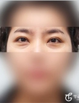 韩国TANGGLE整形祛眼袋手术不愧是减龄神器，做完瞬间变年轻！_术前