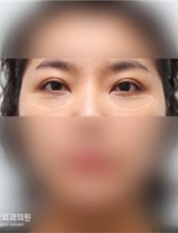韩国TANGGLE整形祛眼袋手术不愧是减龄神器，做完瞬间变年轻！_术后