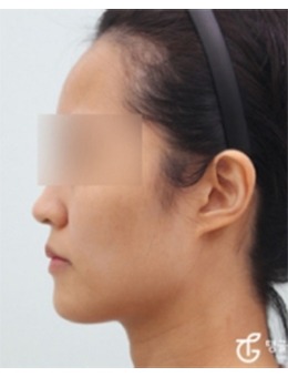 分享韩国TANGGLE整形外科面部填充前后对比图!!改善面部凹陷还你少女轮廓