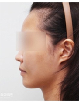 分享韩国TANGGLE整形外科面部填充前后对比图!!改善面部凹陷还你少女轮廓