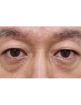 -分享!!!韩国Merry整形外科医院眼底脂肪重置前后对比,改善眼部状态立减5岁
