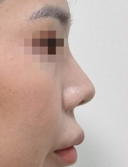 -韩国鼻子小翘鼻整形医院就看merry整形外科,这组鼻修复整形对比图真是绝了!