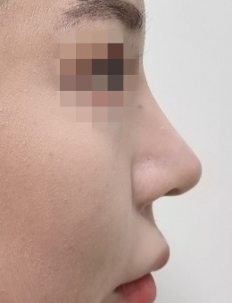 韩国鼻子小翘鼻整形医院就看merry整形外科,这组鼻修复整形对比图真是绝了!_术后