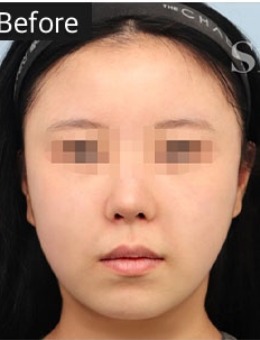 韩国Snow整形的手工吸脂手术绝了!脸颊嘴角+双下巴下颌线吸脂后大变样!