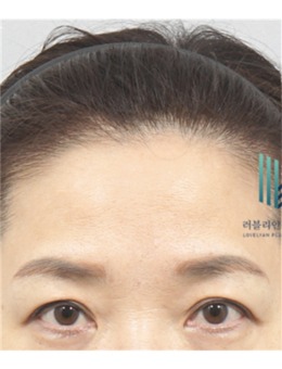 韩国额头提升做的好的医院有哪些?乐于丽颜整形额头提升手术很出名!