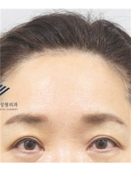 韩国额头提升做的好的医院有哪些?乐于丽颜整形额头提升手术很出名!