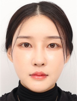来韩国DL整形外科做了轮廓三件套和鼻修复!术后秒变精致女神!