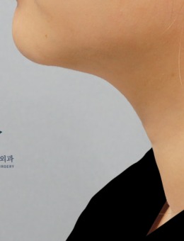 -家人们谁懂啊,韩国乐于丽颜整形颈部提升太香了,做完真的年轻10岁！