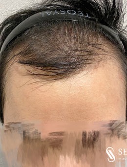 韩国Seojin整形外科植发技术一绝，秃顶植发实例图看一下！