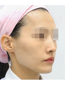 分享韩国Toxnfill皮肤科三成店面部填充前后对比图,改善面部凹陷做回