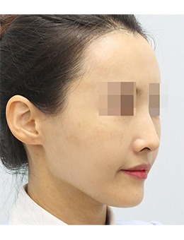 -分享韩国Toxnfill皮肤科三成店面部填充前后对比图,改善面部凹陷做回
