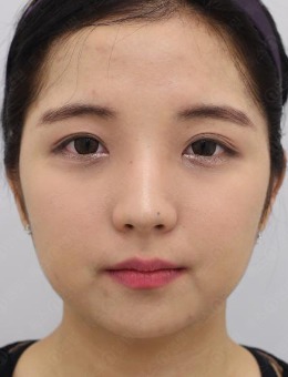 分享韩国Toxnfill皮肤科三成店瘦脸及面部美白前后对比照_术前
