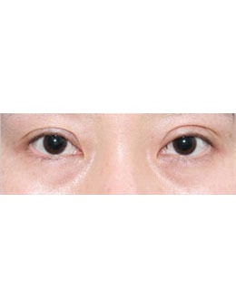 韩国赫尔希整形双眼皮修复手术真人实例图来啦，真的很自然！