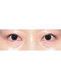 -韩国赫尔希整形双眼皮修复手术真人实例图来啦，真的很自然！