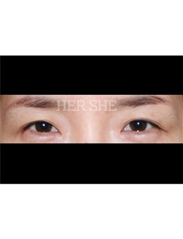 -韩国赫尔希切开双眼皮特色是自然且真实,赫尔希眼部整形手术对比照分享!