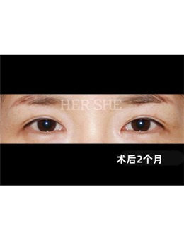 -韩国赫尔希切开双眼皮特色是自然且真实,赫尔希眼部整形手术对比照分享!