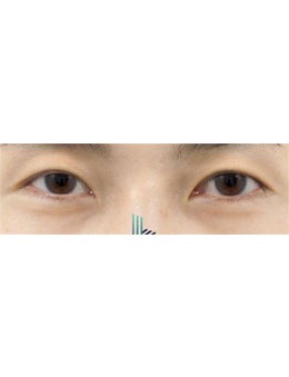 韩国乐于丽颜整形外科打造灵动双眼皮，重塑眼部魅力！_术前