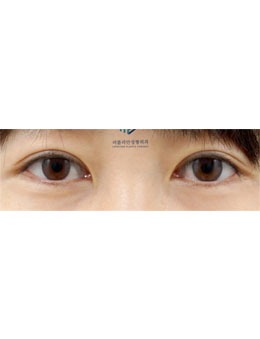 韩国乐于丽颜整形外科打造灵动双眼皮，重塑眼部魅力！