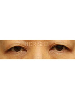 来韩国赫尔希整形做双眼皮，让你变得更加自信迷人！