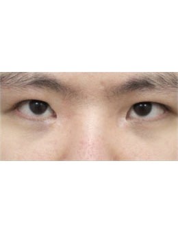 韩国SONE整形第三次眼修复+内眼角复原手术实例分享，术后真的很自然！