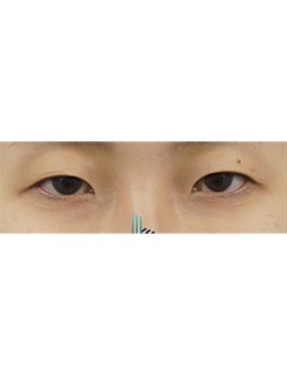 韩国乐于丽颜整形外科做眼睛怎么样?放大双眼更贴合五官呈现自然美感