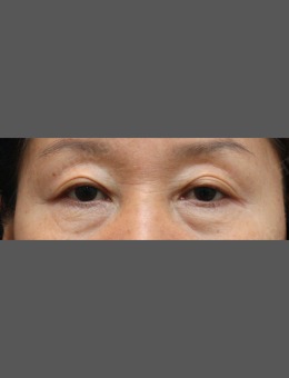韩国赫尔希整形外科眼袋手术案例来啦，几乎无恢复期的眼袋手术了解一下_术前