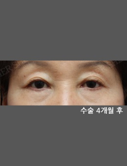 韩国赫尔希整形外科眼袋手术案例来啦，几乎无恢复期的眼袋手术了解一下