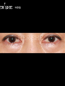 韩国赫尔希眼部特色是自然真实,从这组赫尔希宽降窄+提肌肉手术对比照就能看出!_术前
