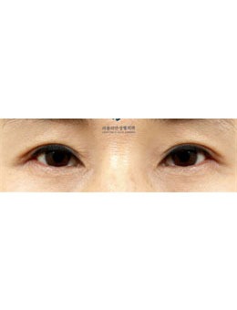 -来韩国乐于丽颜整形做双眼皮，拥有年轻又漂亮的眼睛！