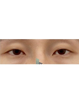 韩国乐于丽颜整形外科做眼整形非常好！眼整形手术图快看！